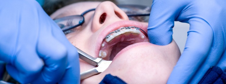 Kind wird in offenem Mund eine Zahnspange eingesetzt