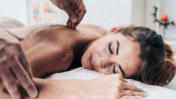 Frau bekommt in nacktem Rücken Akupunkturnadeln gesteckt