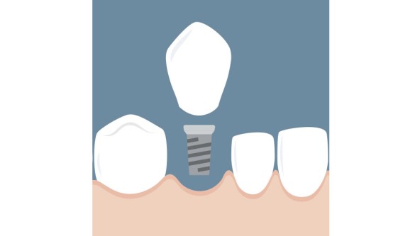 Zahnersatz: Implantat