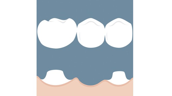 Zahnersatz: Zahnbrücke