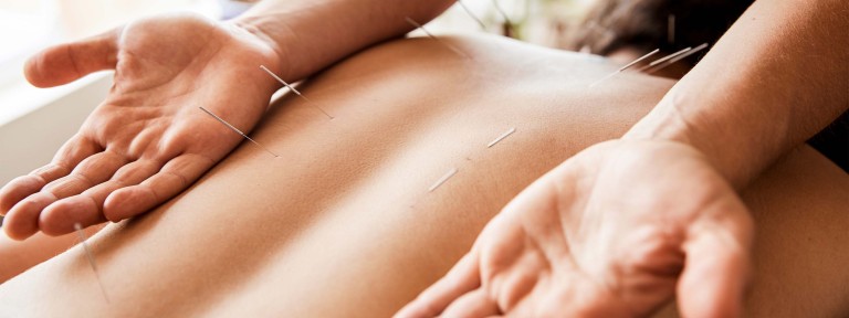 Frau liegt auf Bauch und bekommt Akupunkturnadeln in den Rücken