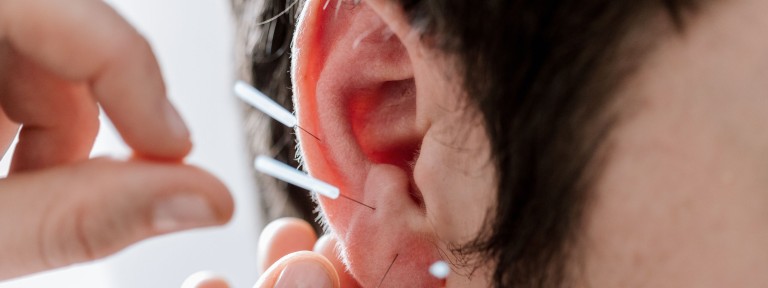 Mann bekommt Akupunktur-Nadeln ins Ohr gesteckt